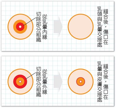 乳暈生毛|乳頭毛